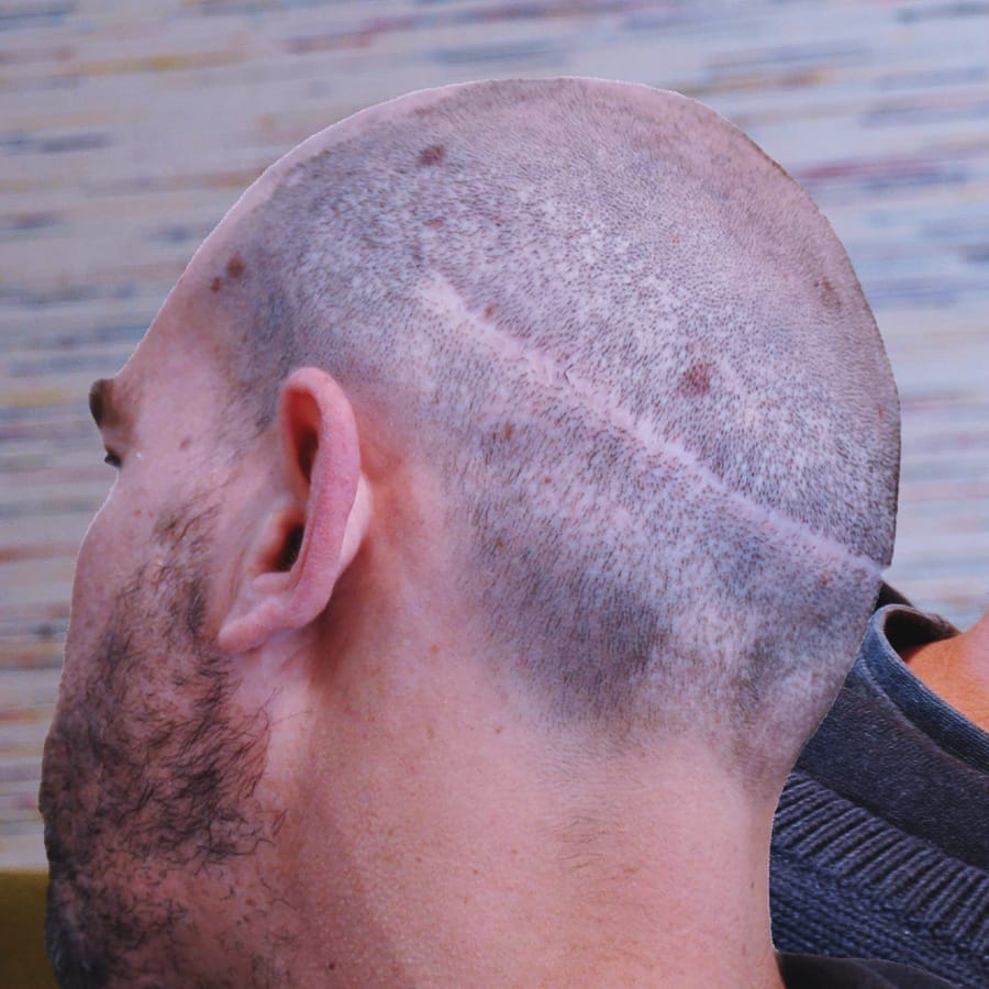 Centre_Micropigmentation-Cicatrices-Header